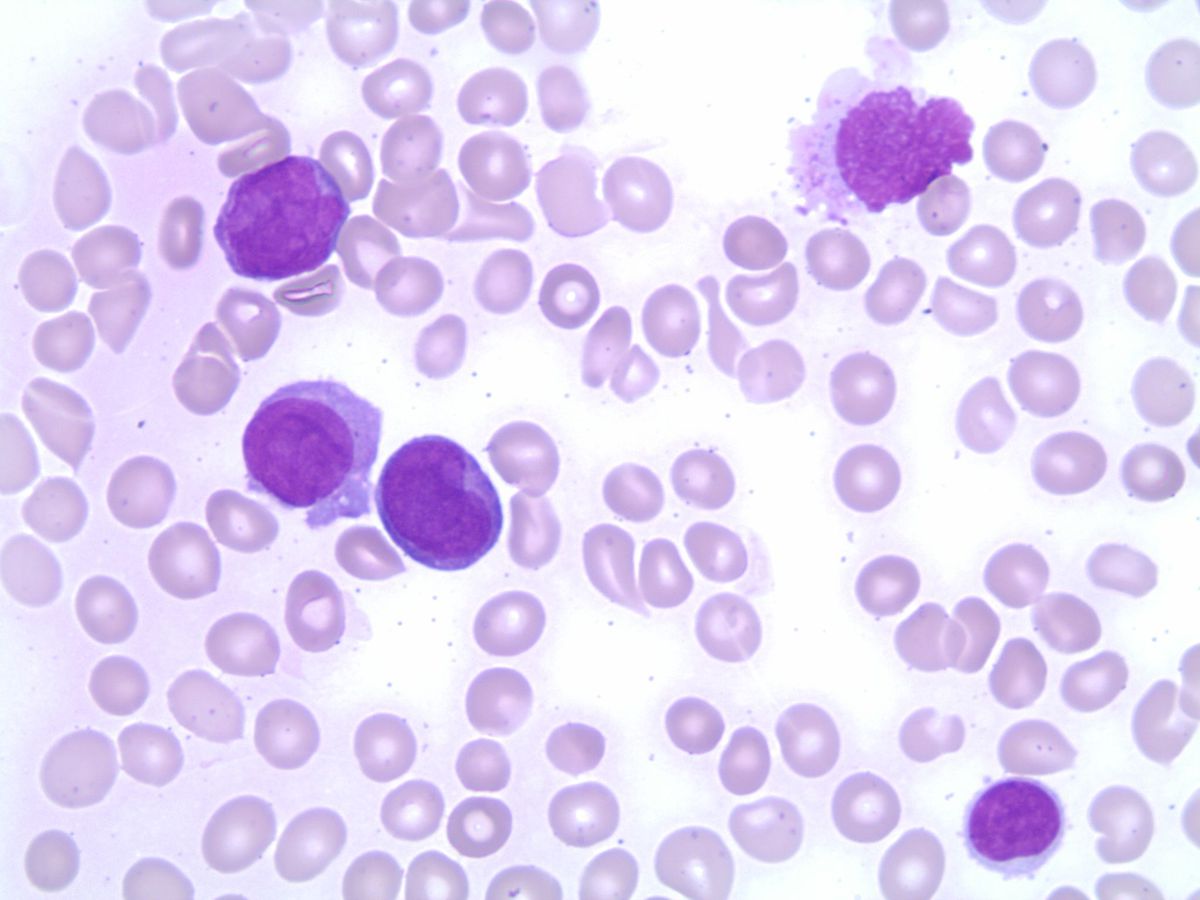 Blasts with folded nuclei and prominent nucleoli